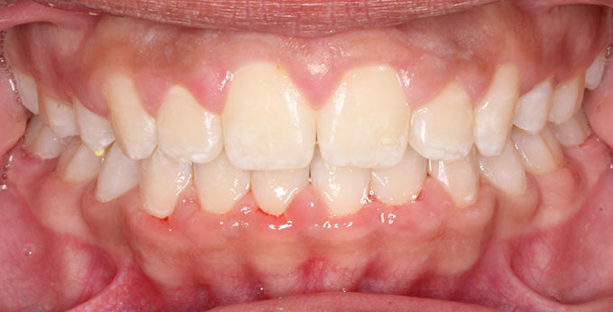 Children teeth after perth orthodontic treatment for severe dental crowding and misalignment